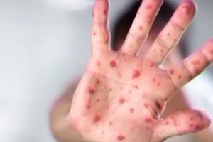 Fact-check: Did illegal immigration cause US measles outbreak?